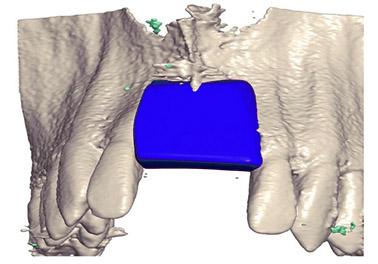 Einsatz des Knochenimplantats