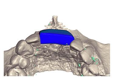 Kiefer mit Knochenimplantat von oben