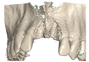 3D-Röntgenbild vor dem Kochenaufbau